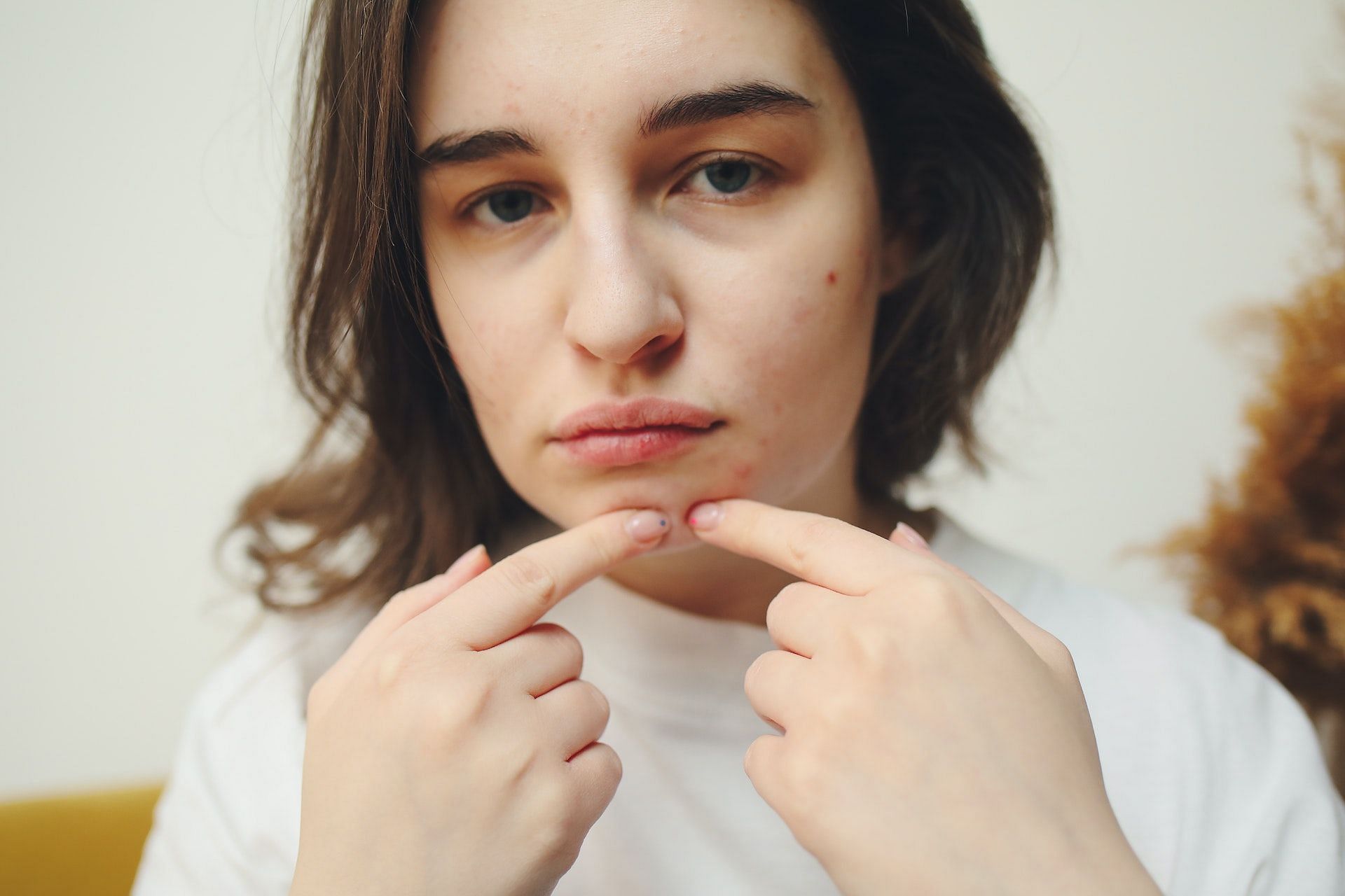 تشمل فوائد اشواغاندا للبشرة منع حب الشباب والبثور. (الصورة من Pexels / Polina Tankilevitch)
